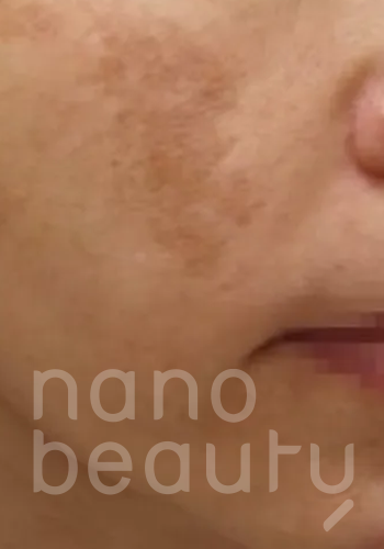 Nano Beauty-前後相_55583452 Nano Beauty-前後相_55583452