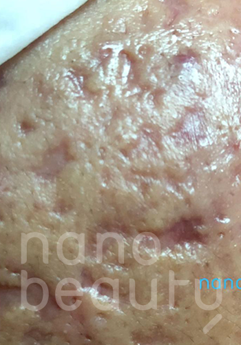 Nano Beauty-前後相_68454 Nano Beauty-前後相_68454